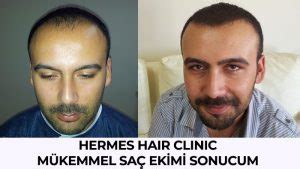 hermes hair clinic saç ekim merkezi